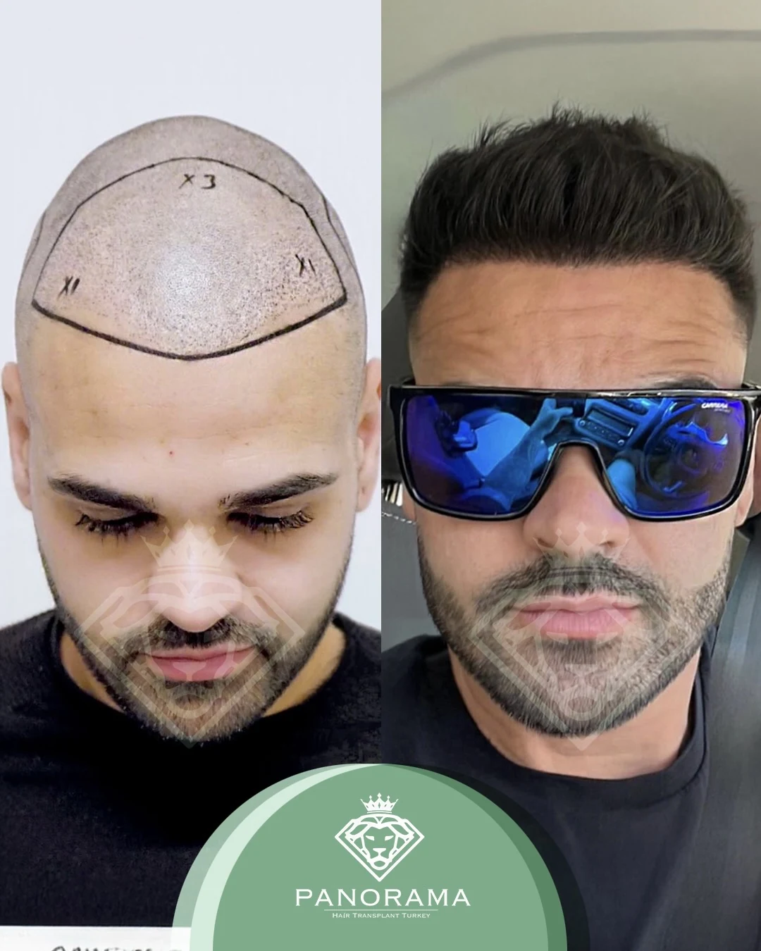 زراعة الشعر قبل وبعد — الحالة IG-17، انحسار خط الشعر