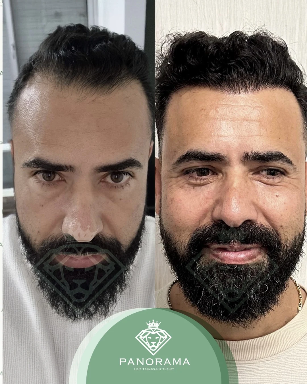 زراعة الشعر قبل وبعد — الحالة IG-19، الشعر واللحية