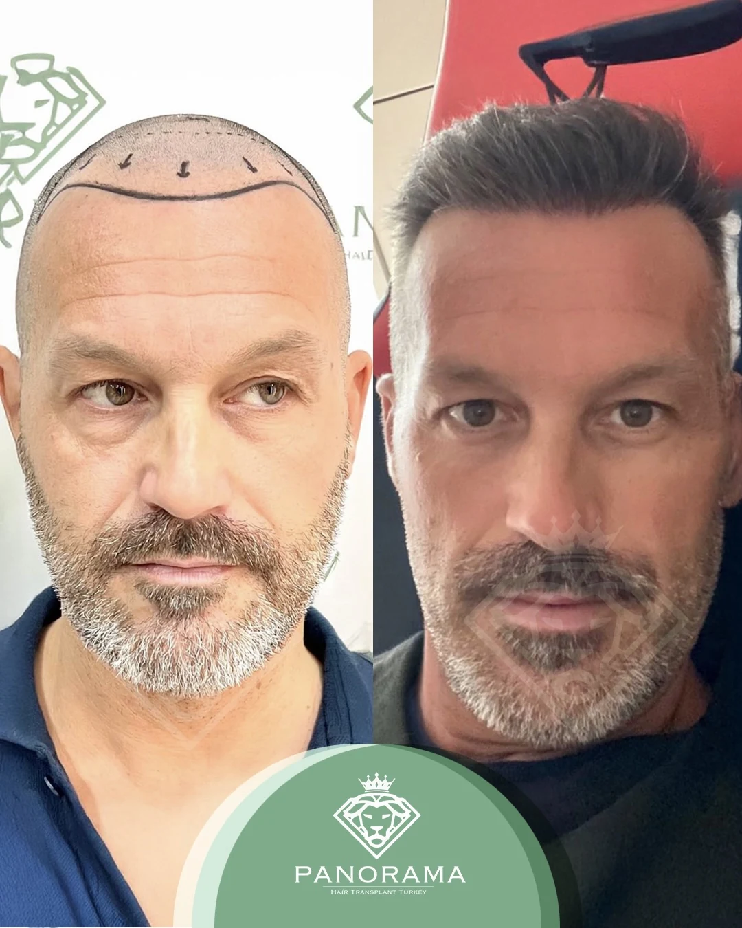 زراعة الشعر قبل وبعد — الحالة IG-20، انحسار خط الشعر