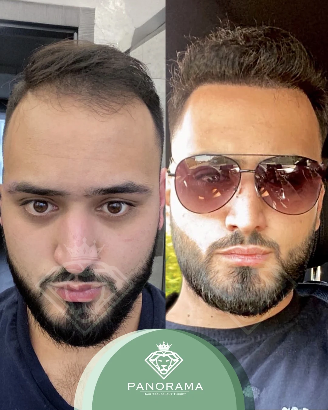 زراعة الشعر قبل وبعد — الحالة IG-21، انحسار خط الشعر