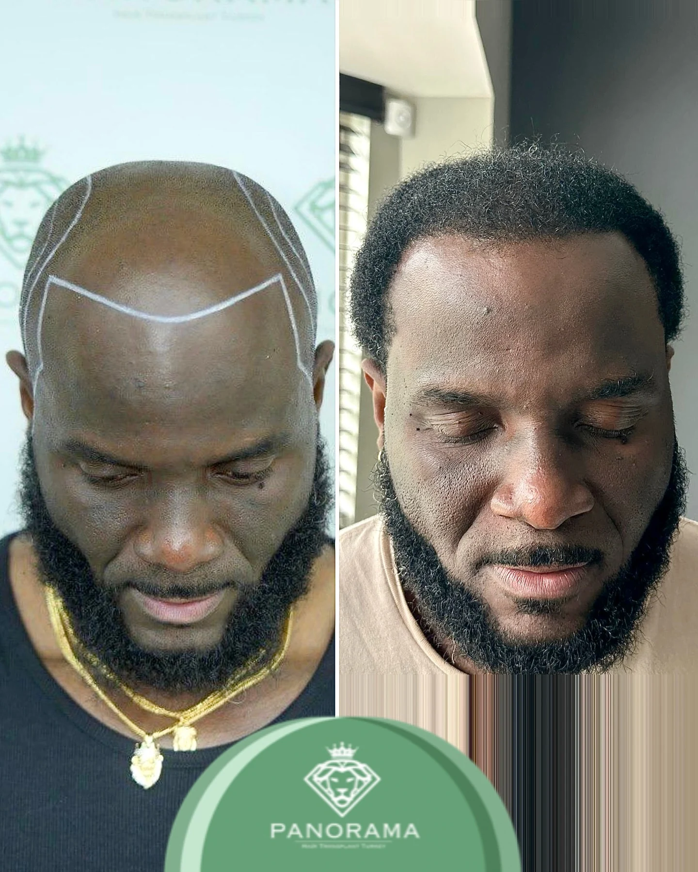 زراعة الشعر قبل وبعد — الحالة IG-08، انحسار خط الشعر