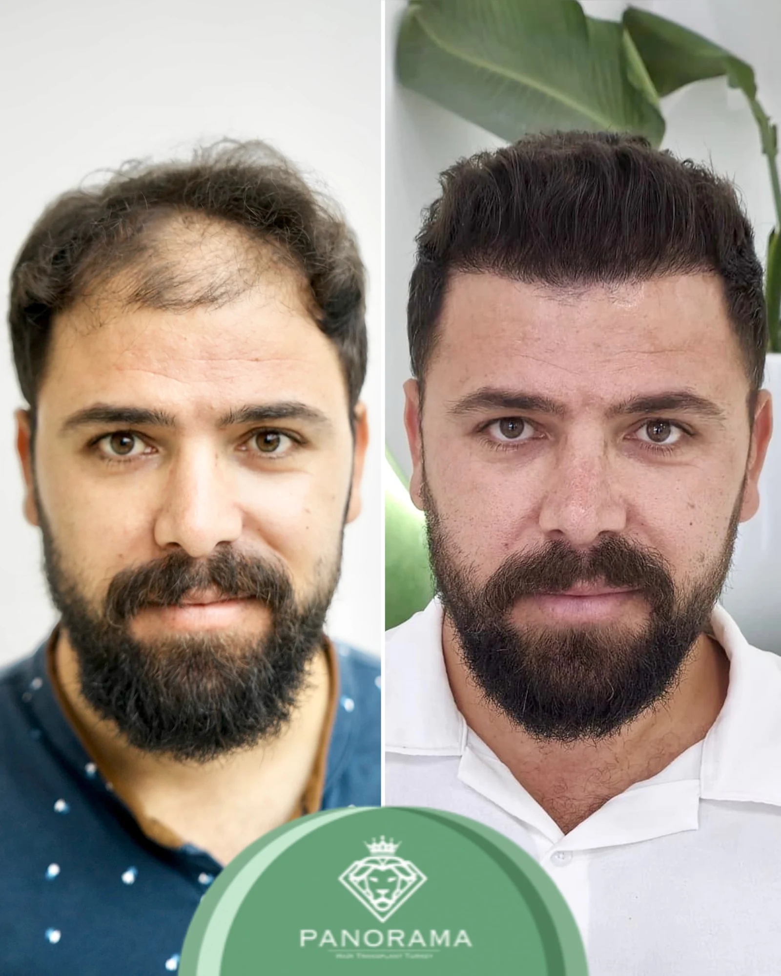 Hair transplant before and after — case IG-07, receding hairline