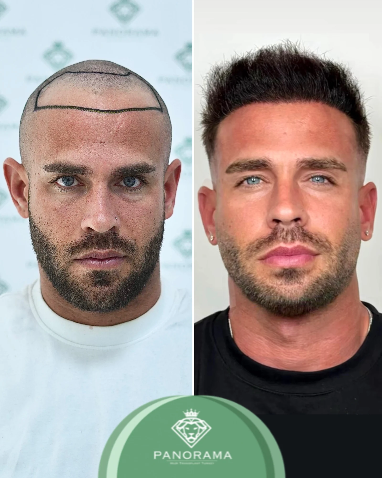 Hair transplant before and after — case IG-05, receding hairline