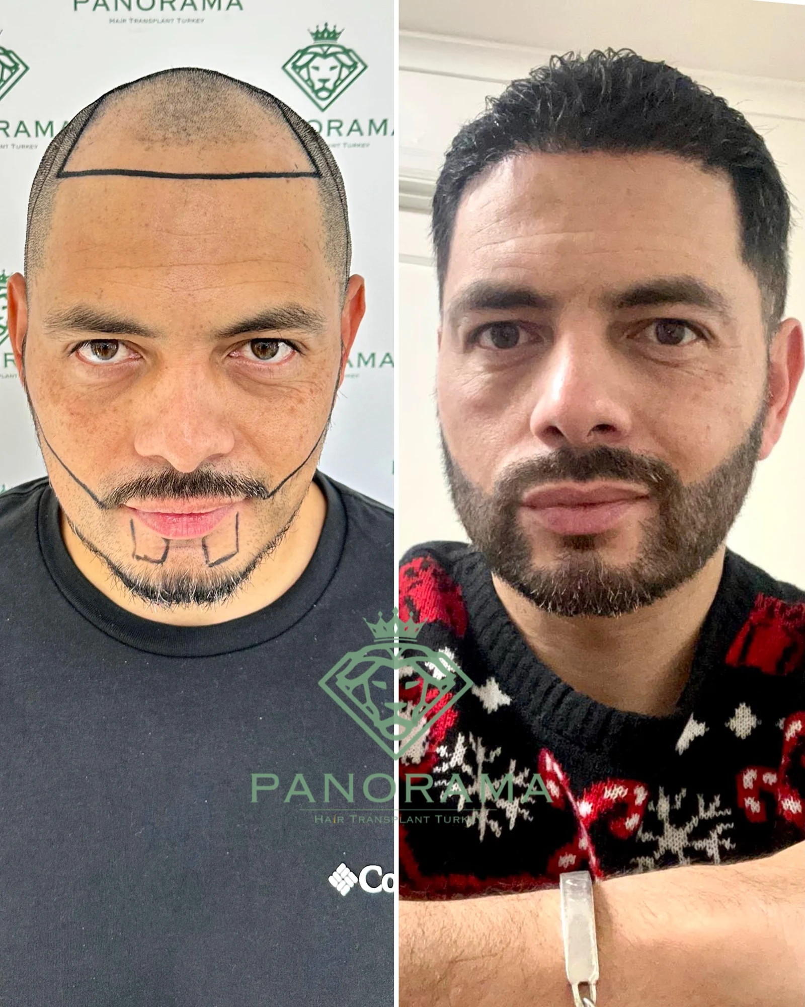 Hair transplant before and after — case IG-06, hair & beard