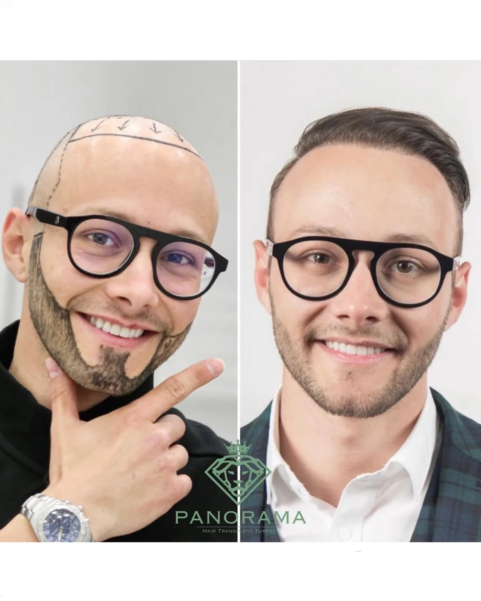 Hair transplant before and after — case IG-09, hair & beard