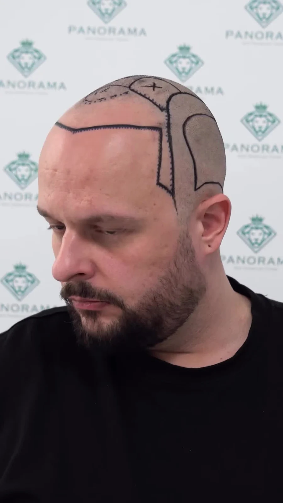 The details of hairline design