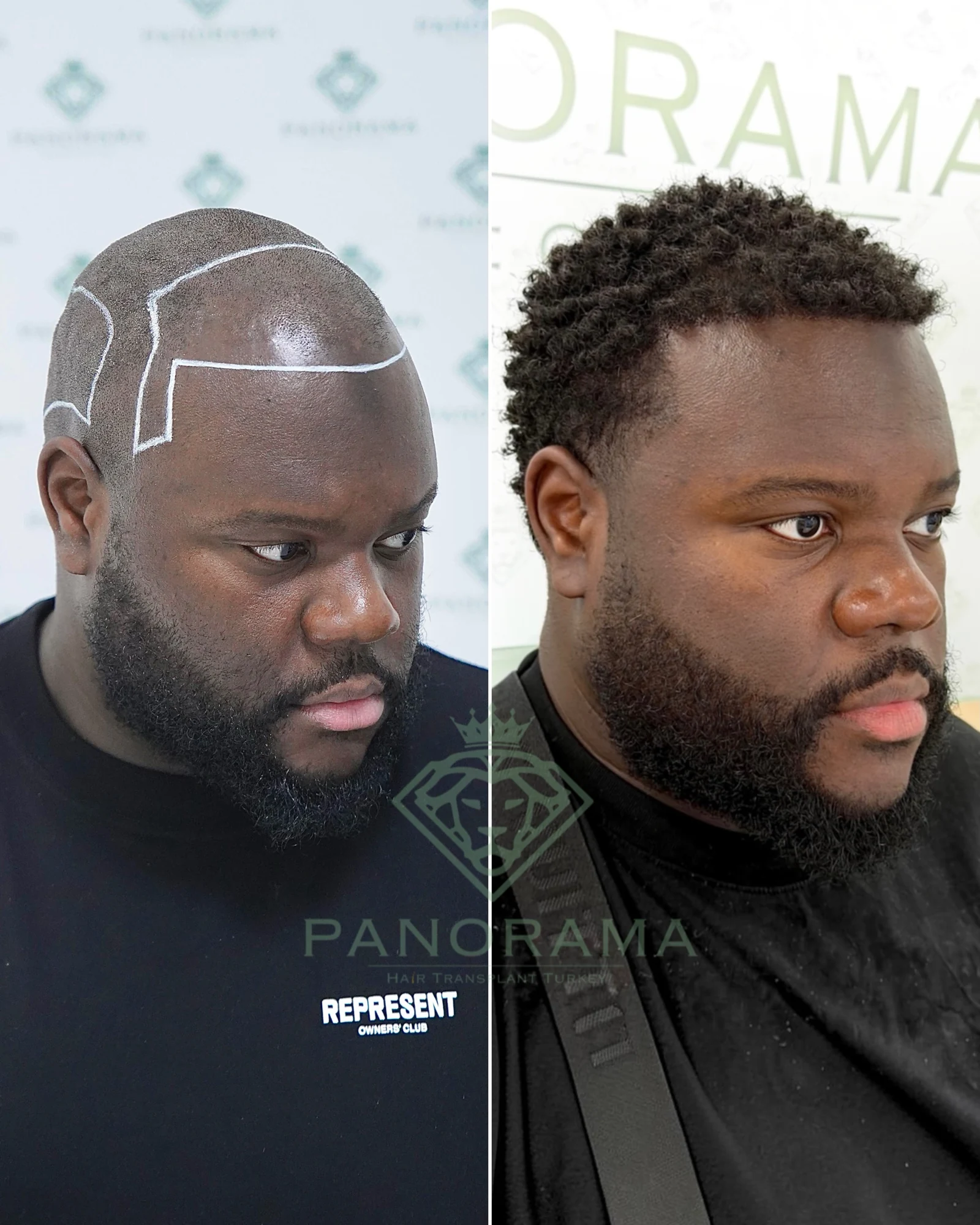 Hair transplant before and after — case IG-02, receding hairline