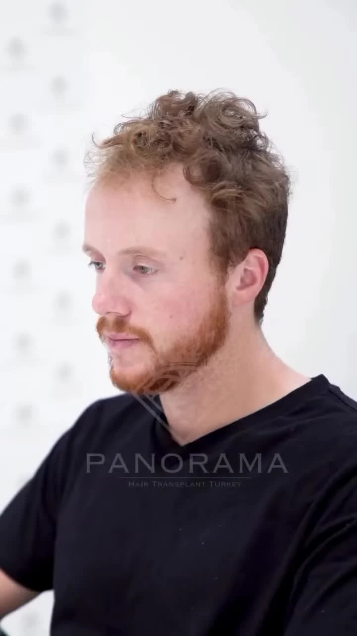 Planning a personal hairline