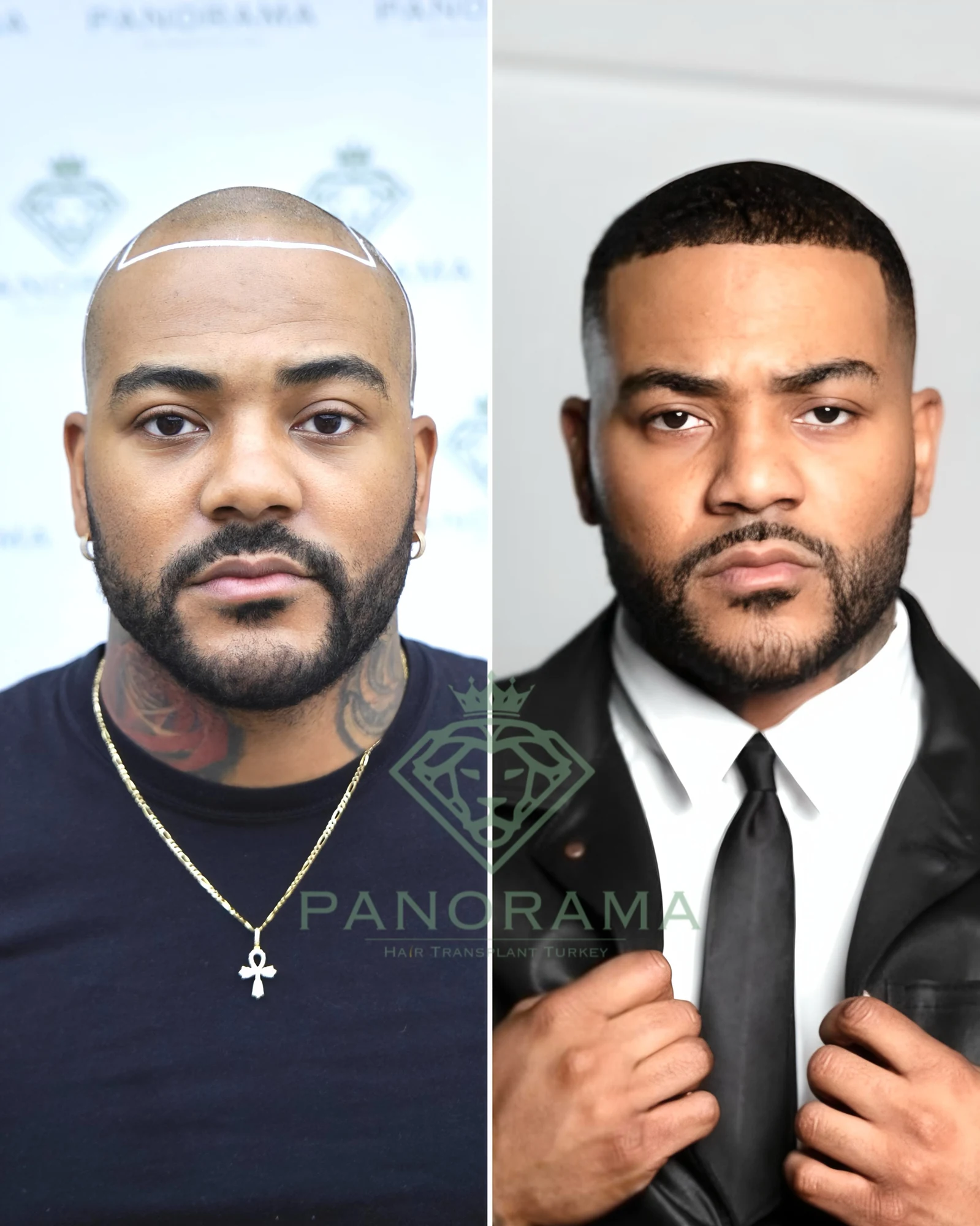 Hair transplant before and after — case IG-10, receding hairline
