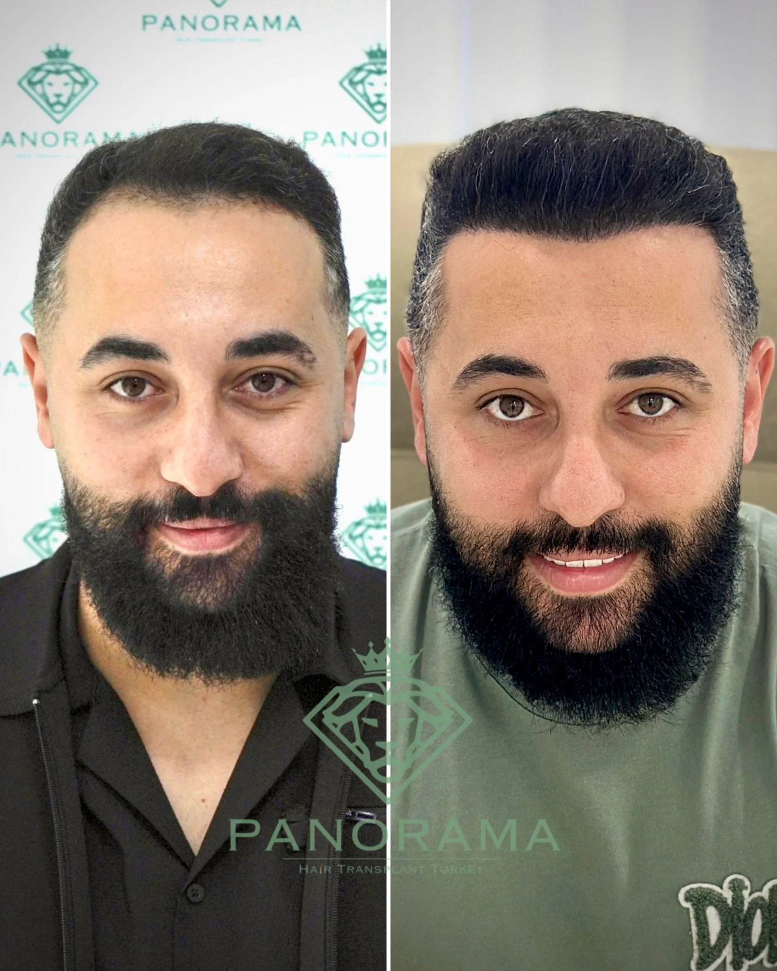 Hair transplant before and after — case IG-04, receding hairline