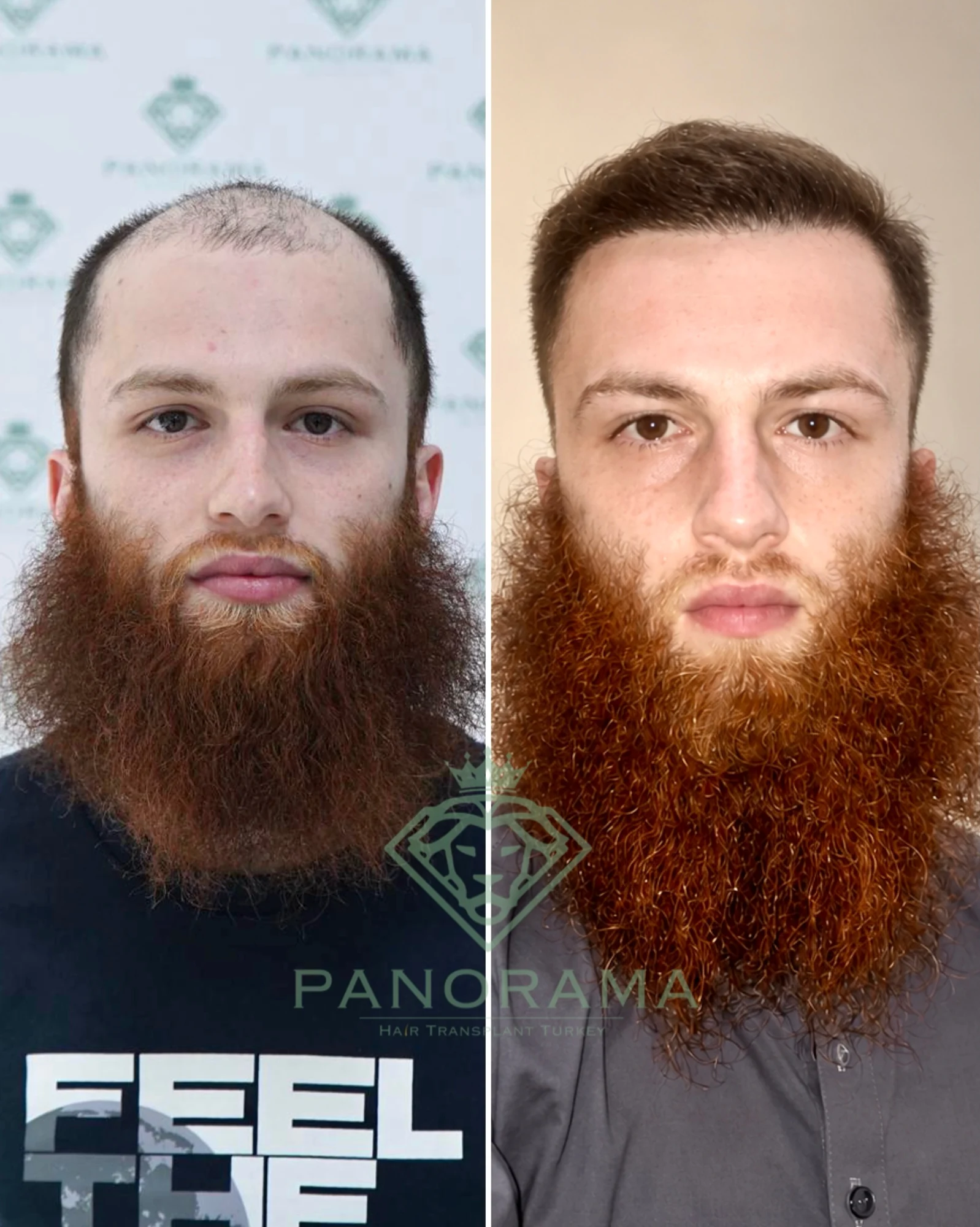 Hair transplant before and after — case IG-03, receding hairline