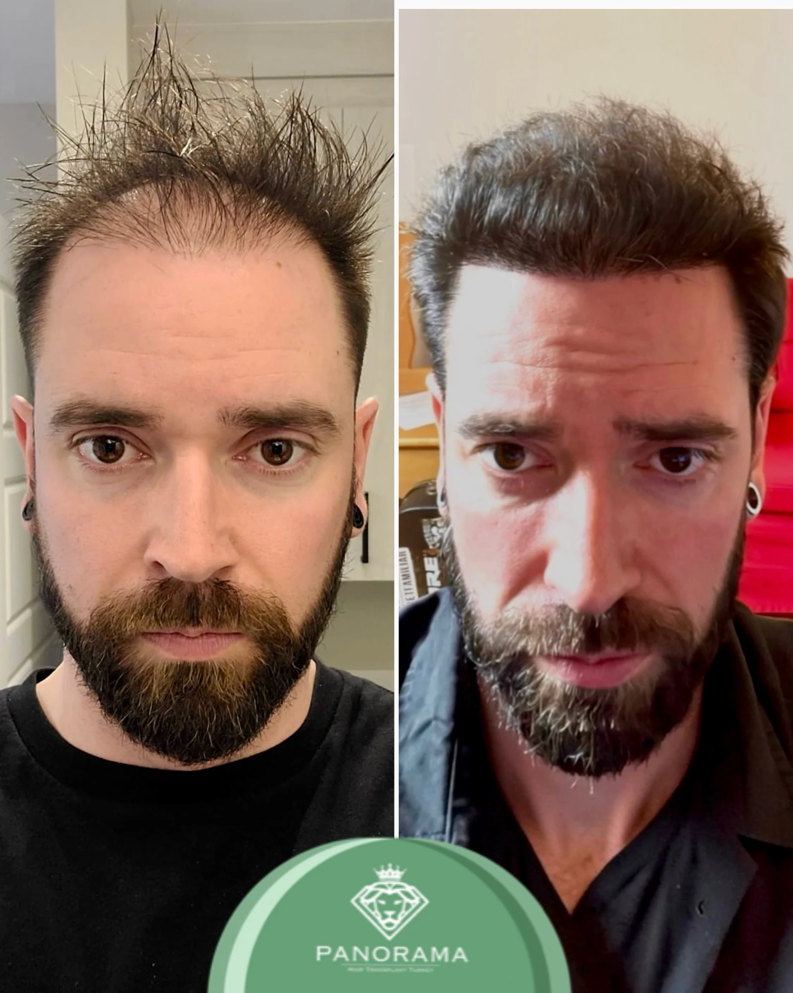 Hair transplant before and after — case IG-01, receding hairline