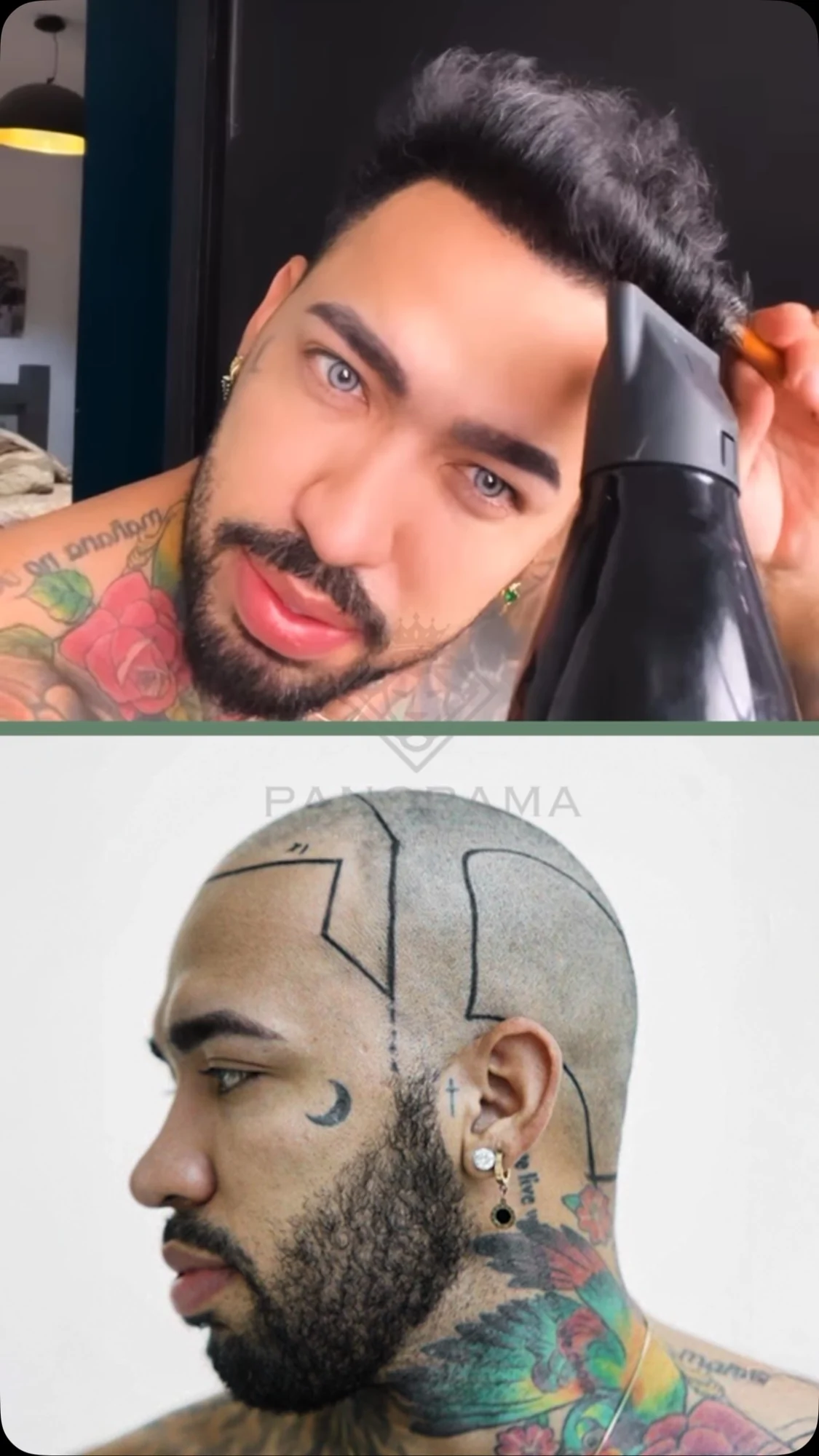 A patient’s hair restoration journey