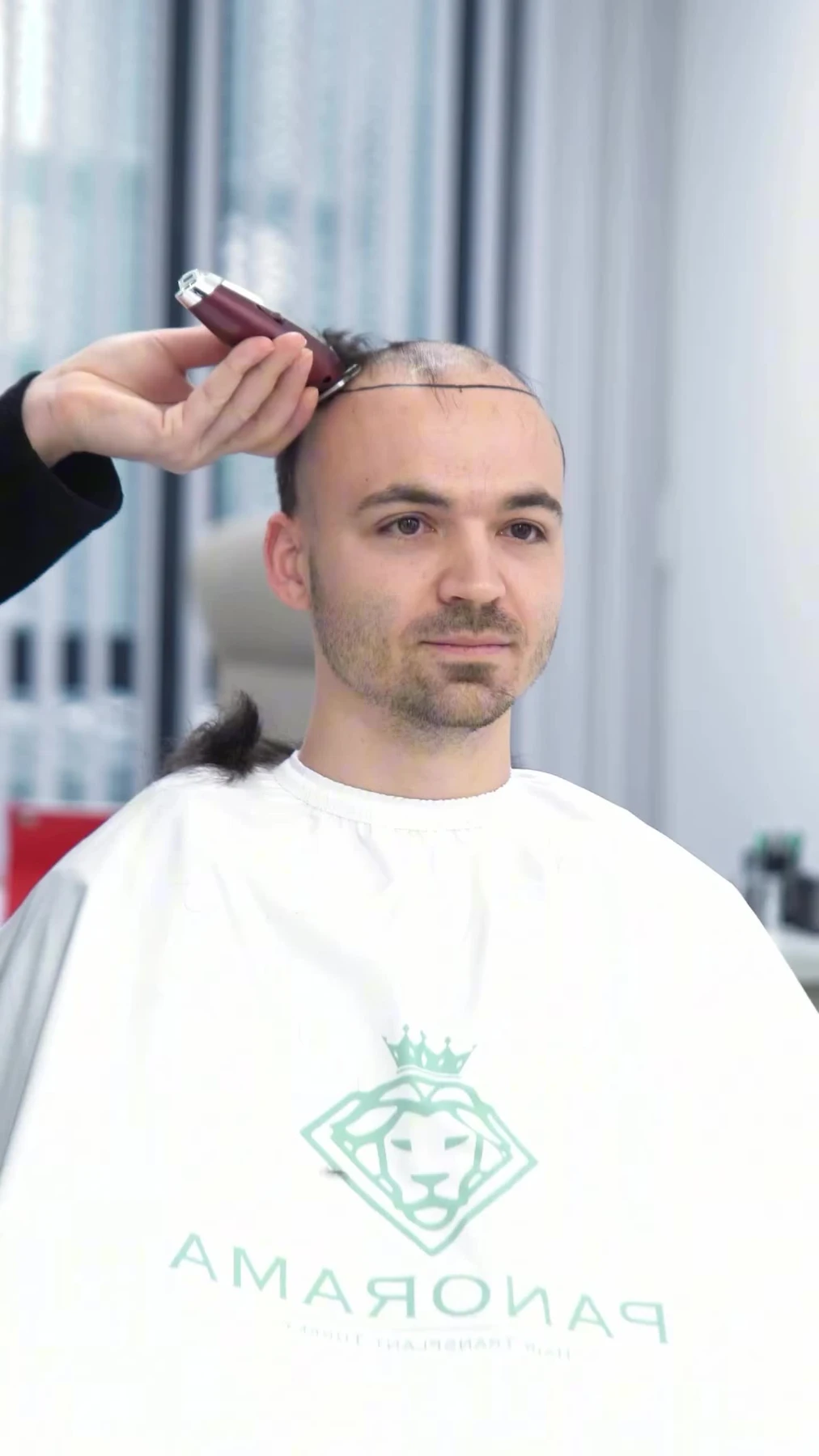 Hairline planning and patient preparation at Panorama Hair Turkey