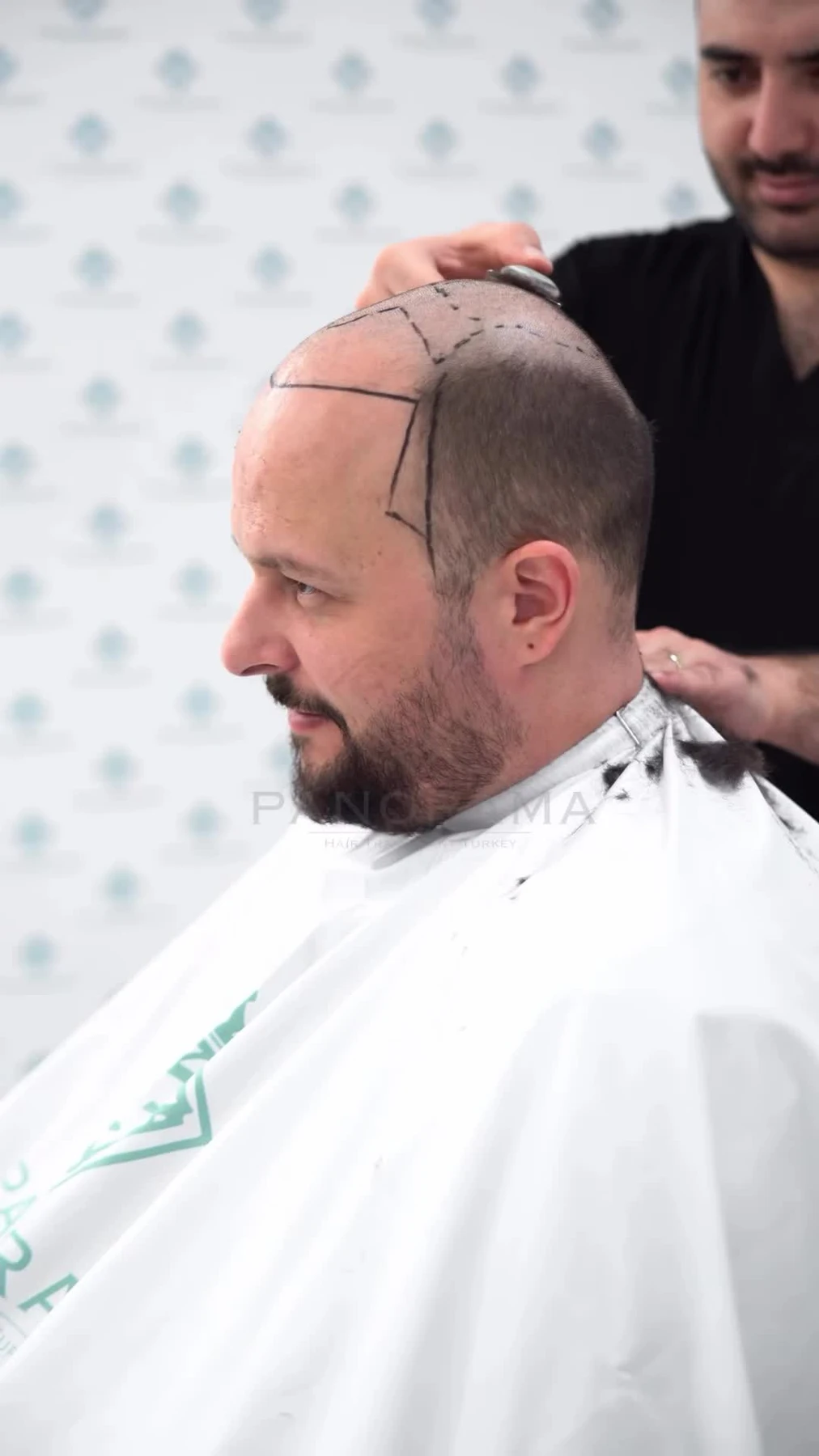 Beard Transplantation
