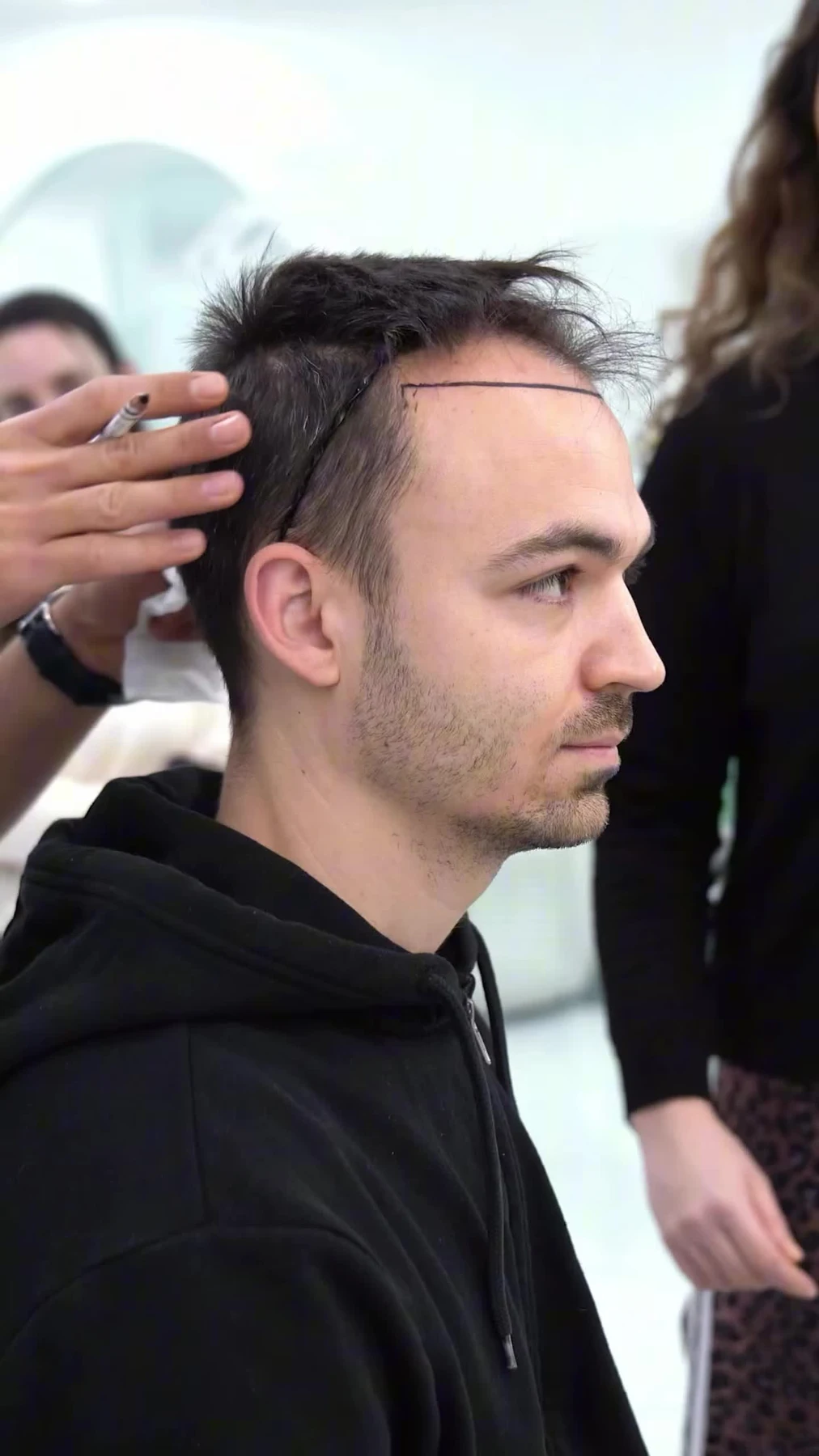 Hairline planning and patient preparation at Panorama Hair Turkey