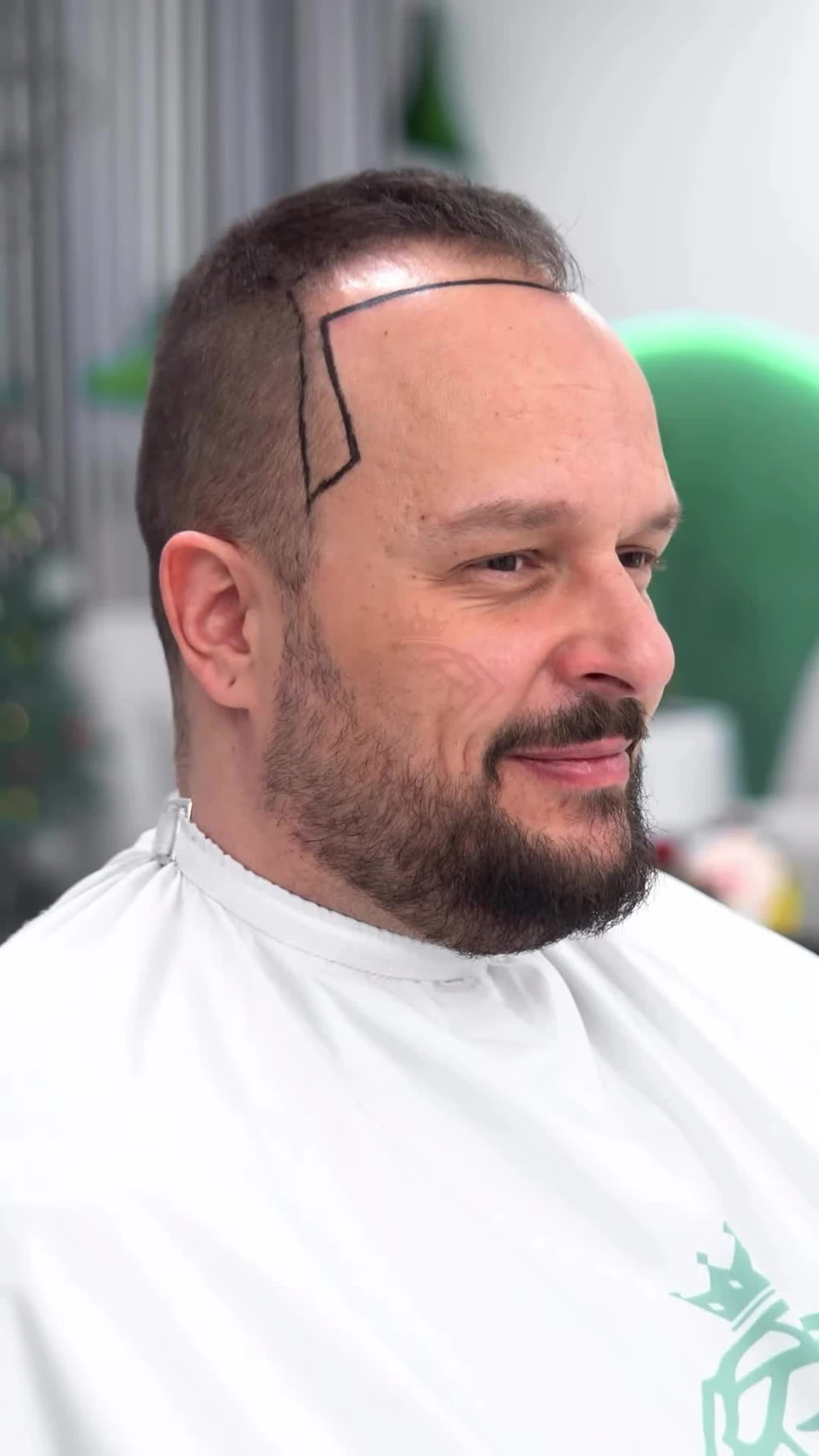 Hairline planning and patient preparation at Panorama Hair Turkey