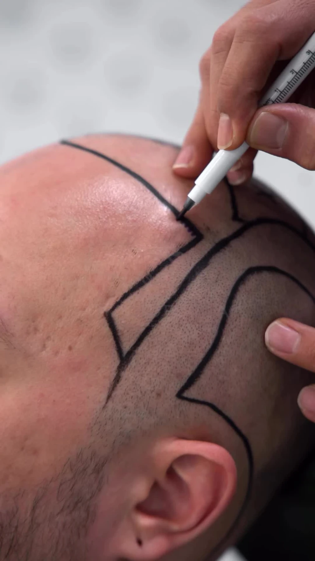 Sapphire Hair Transplant