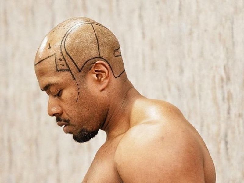 hair transplant surgery
