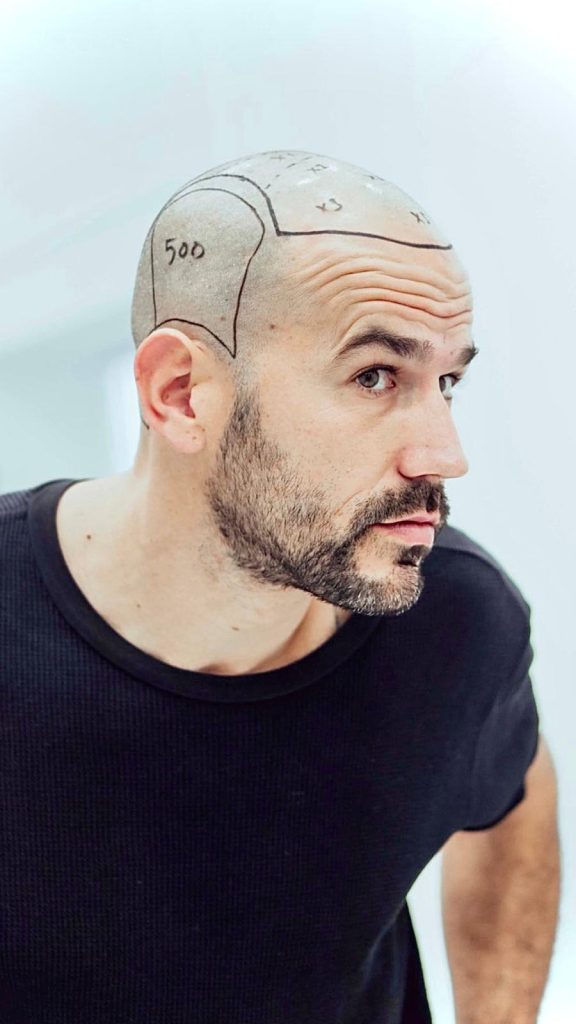 hair transplant turkey