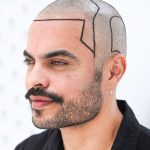 hair transplant
