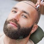 hair transplant turkey