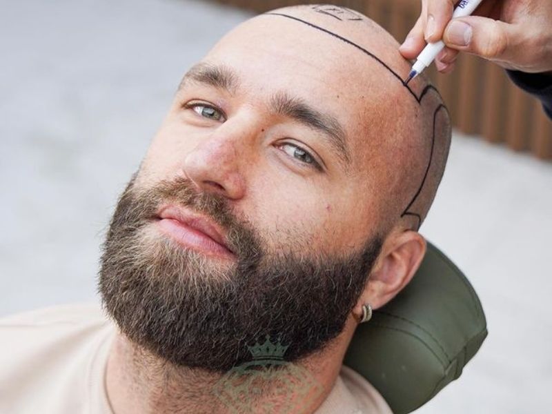 hair transplant turkey