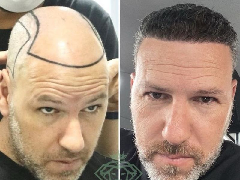 hair transplant turkey