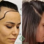 hair transplant