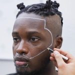 hair transplant