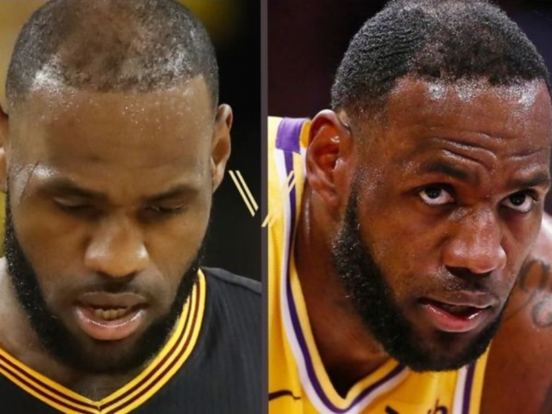 hair transplantation