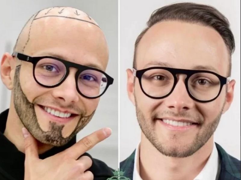 Bald Spot