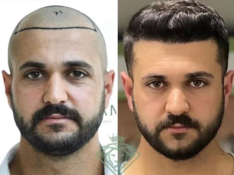 before after