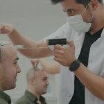 hair transplant