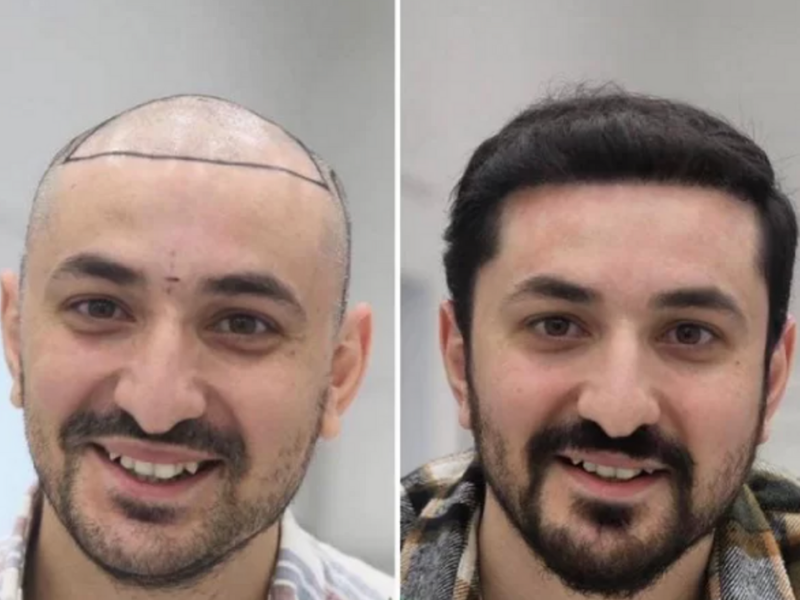 best hair transplant